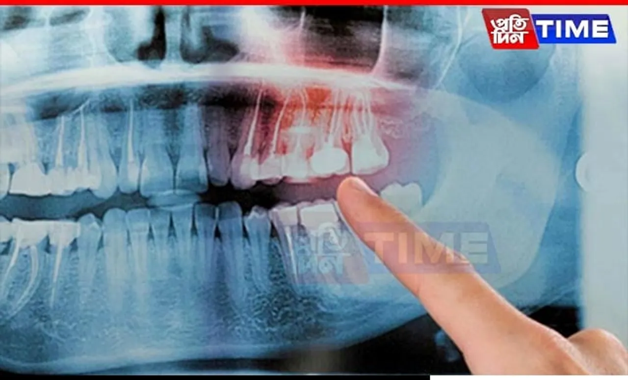 Tooth Loss Linked to Increased Risk of Fatal Heart Diseases, New Study Finds